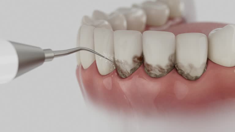 Reliable Dental Implants contractor in Cicero, IN by Smile Center Dentistry